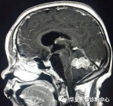 【病例】小脑蚓部淋巴瘤1例MR影像表现 【病例】小脑蚓部淋巴瘤1例MR影像表现