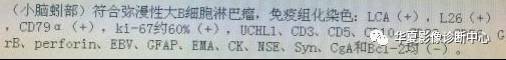 【病例】小脑蚓部淋巴瘤1例MR影像表现 【病例】小脑蚓部淋巴瘤1例MR影像表现