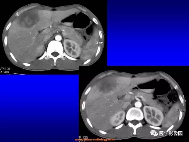 【病例】肝脏炎性肌纤维母细胞瘤1例CT 【病例】肝脏炎性肌纤维母细胞瘤1例CT
