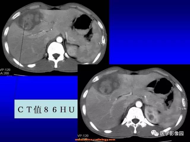 【病例】肝脏炎性肌纤维母细胞瘤1例CT 【病例】肝脏炎性肌纤维母细胞瘤1例CT