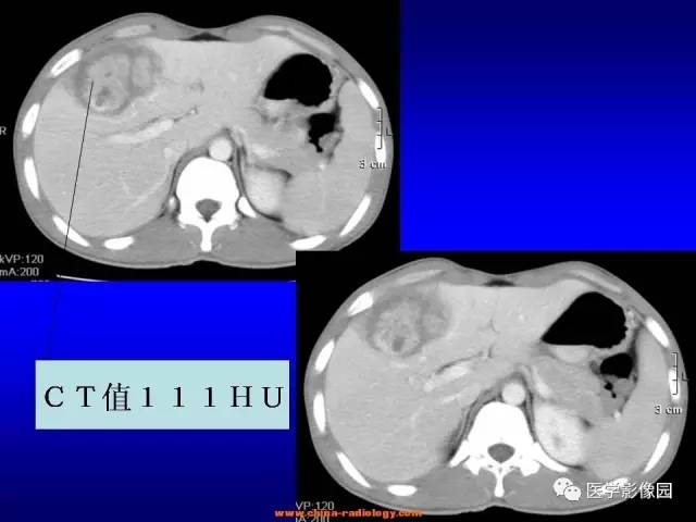 【病例】肝脏炎性肌纤维母细胞瘤1例CT 【病例】肝脏炎性肌纤维母细胞瘤1例CT