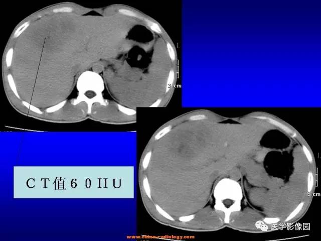 【病例】肝脏炎性肌纤维母细胞瘤1例CT 【病例】肝脏炎性肌纤维母细胞瘤1例CT