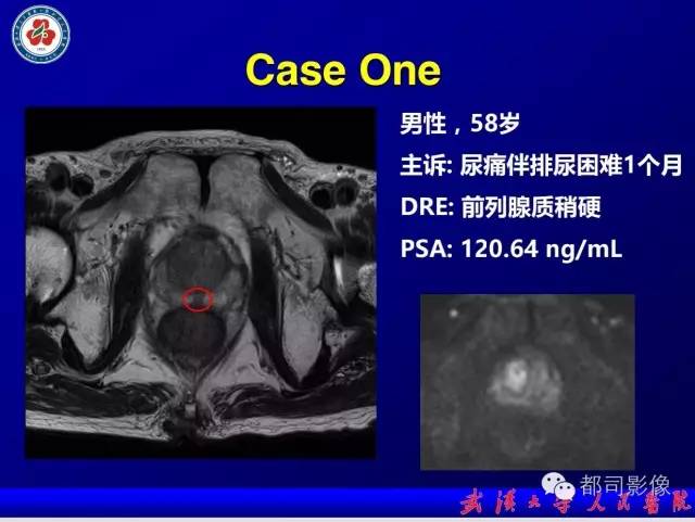 【PPT】小视野扩散加权成像（rFOV-DWI）在前列腺MRI的临床应用