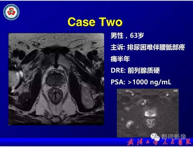【PPT】小视野扩散加权成像（rFOV-DWI）在前列腺MRI的临床应用