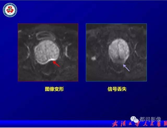 【PPT】小视野扩散加权成像（rFOV-DWI）在前列腺MRI的临床应用