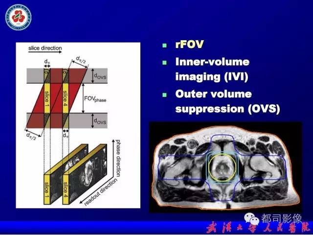 【PPT】小视野扩散加权成像（rFOV-DWI）在前列腺MRI的临床应用