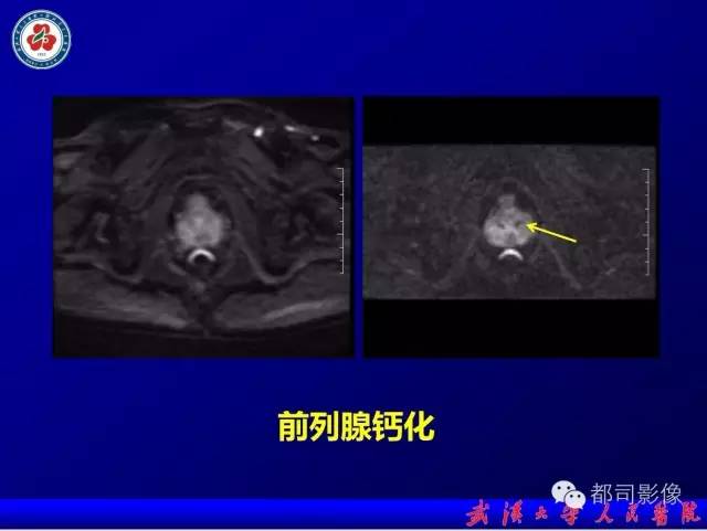 【PPT】小视野扩散加权成像（rFOV-DWI）在前列腺MRI的临床应用