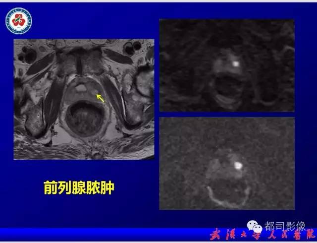 【PPT】小视野扩散加权成像（rFOV-DWI）在前列腺MRI的临床应用