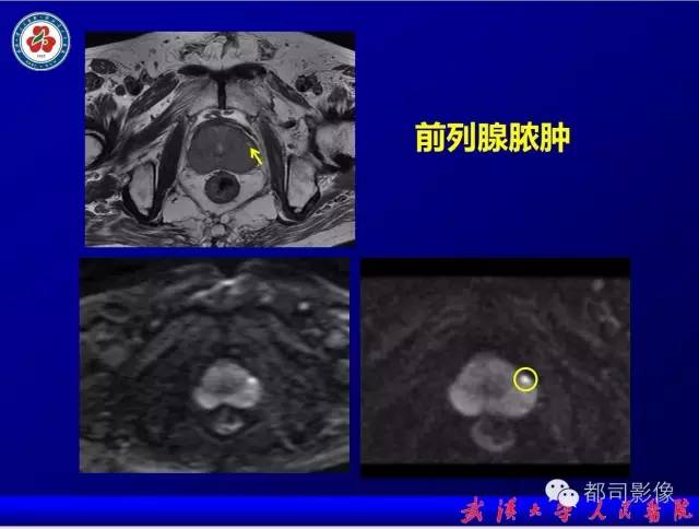 【PPT】小视野扩散加权成像（rFOV-DWI）在前列腺MRI的临床应用