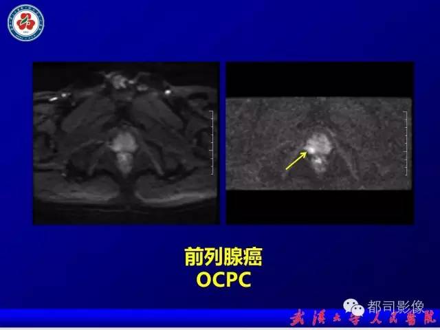 【PPT】小视野扩散加权成像（rFOV-DWI）在前列腺MRI的临床应用