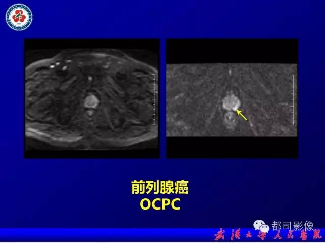 【PPT】小视野扩散加权成像（rFOV-DWI）在前列腺MRI的临床应用