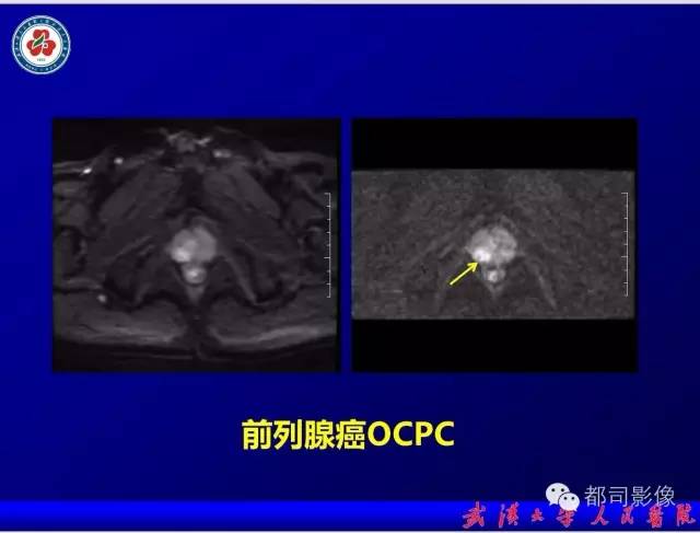 【PPT】小视野扩散加权成像（rFOV-DWI）在前列腺MRI的临床应用
