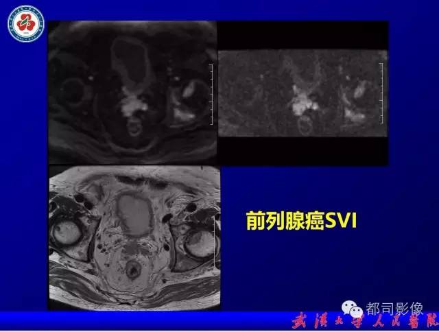 【PPT】小视野扩散加权成像（rFOV-DWI）在前列腺MRI的临床应用