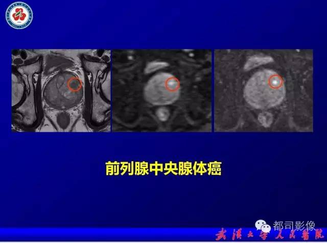 【PPT】小视野扩散加权成像（rFOV-DWI）在前列腺MRI的临床应用