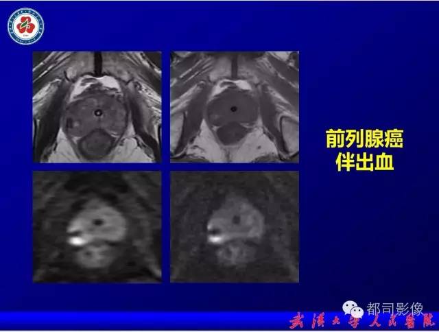 【PPT】小视野扩散加权成像（rFOV-DWI）在前列腺MRI的临床应用