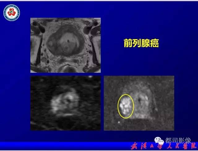 【PPT】小视野扩散加权成像（rFOV-DWI）在前列腺MRI的临床应用