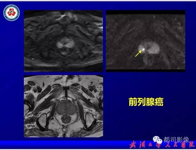 【PPT】小视野扩散加权成像（rFOV-DWI）在前列腺MRI的临床应用