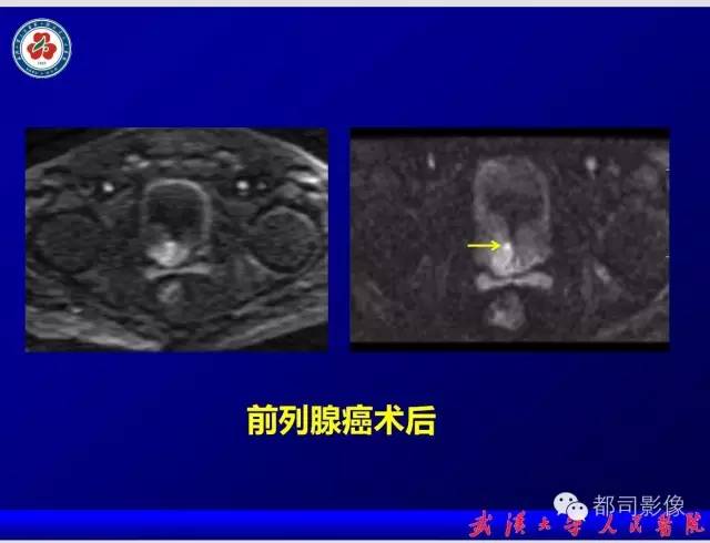 【PPT】小视野扩散加权成像（rFOV-DWI）在前列腺MRI的临床应用
