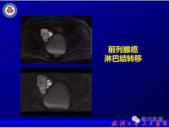 【PPT】小视野扩散加权成像（rFOV-DWI）在前列腺MRI的临床应用