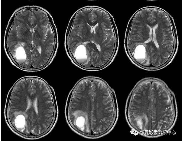【病例】脑囊性转移瘤伴瘤内出血1例MR