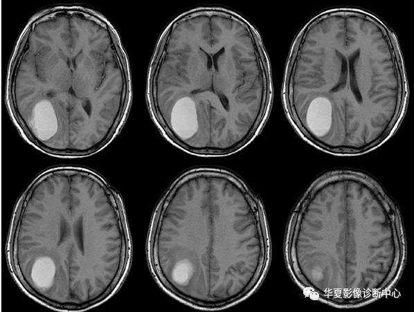 【病例】脑囊性转移瘤伴瘤内出血1例MR