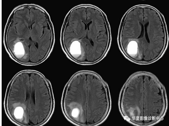 【病例】脑囊性转移瘤伴瘤内出血1例MR