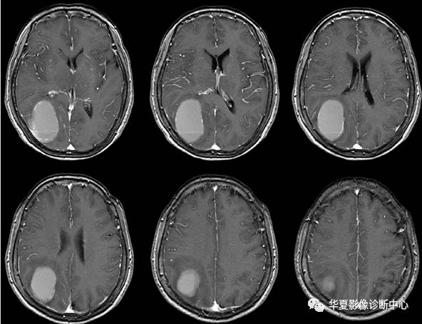 【病例】脑囊性转移瘤伴瘤内出血1例MR