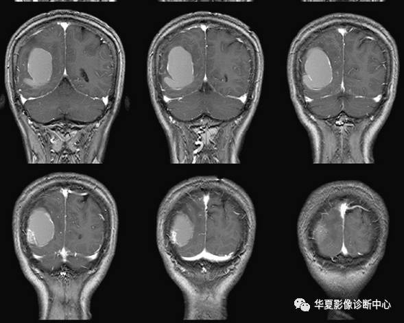 【病例】脑囊性转移瘤伴瘤内出血1例MR