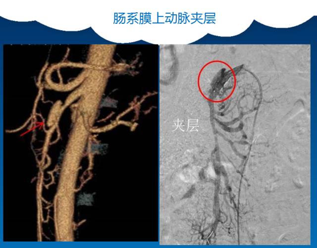 【PPT】肠系膜上动脉夹层