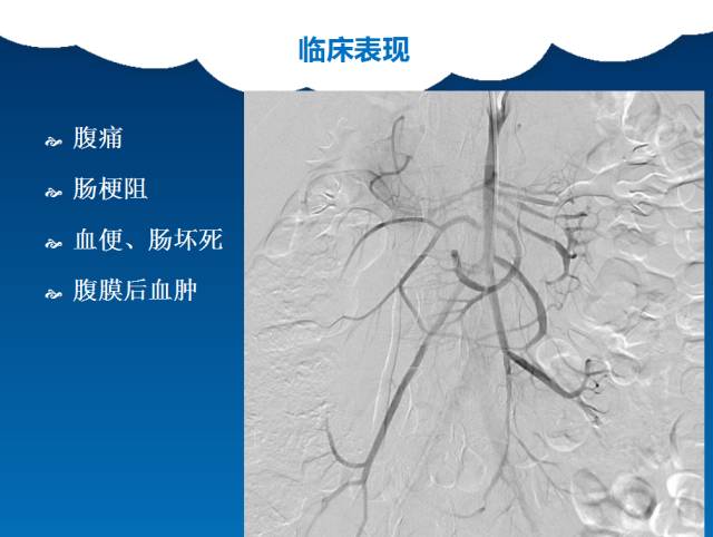 【PPT】肠系膜上动脉夹层