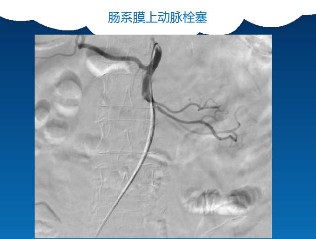 【PPT】肠系膜上动脉夹层