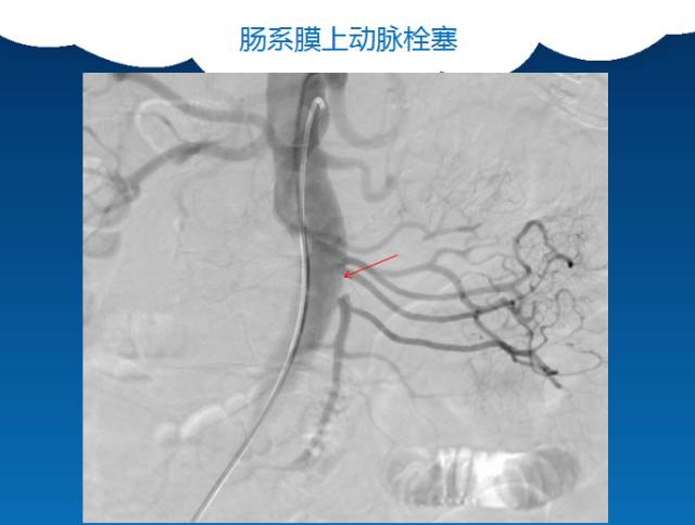 【PPT】肠系膜上动脉夹层