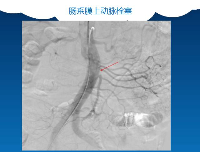 【PPT】肠系膜上动脉夹层
