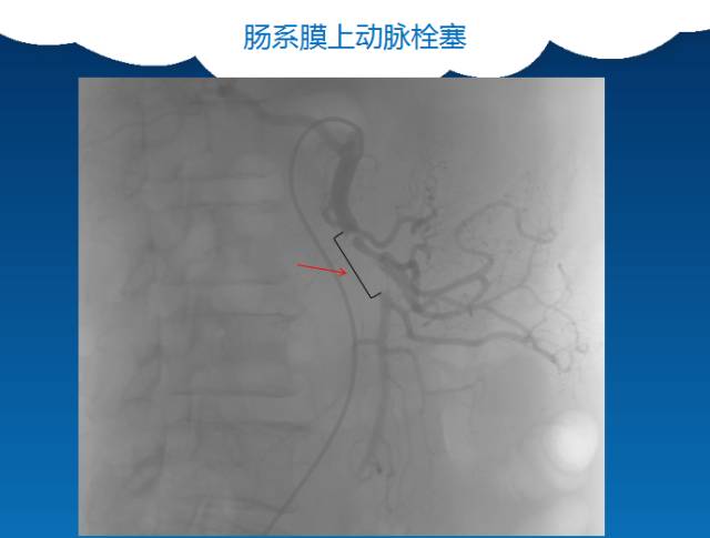 【PPT】肠系膜上动脉夹层