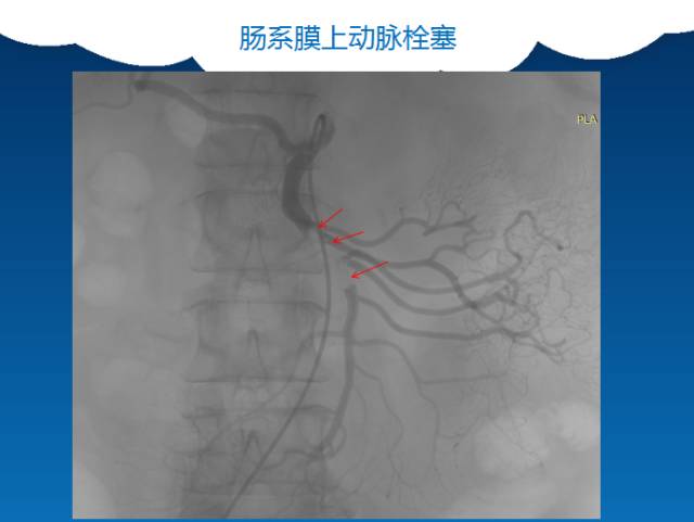 【PPT】肠系膜上动脉夹层