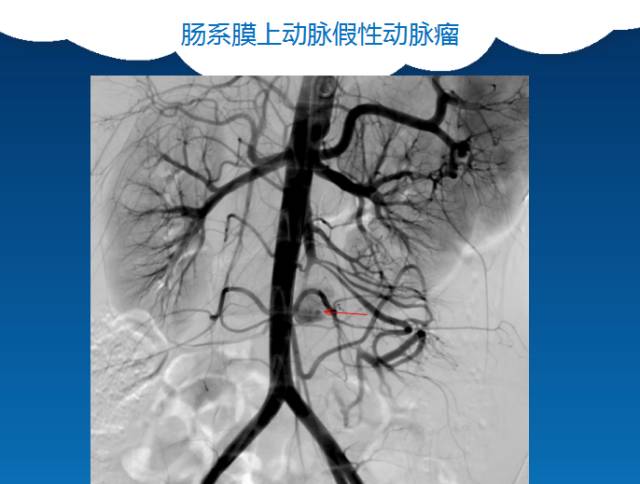 【PPT】肠系膜上动脉夹层