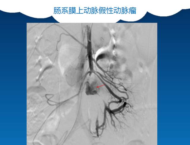 【PPT】肠系膜上动脉夹层