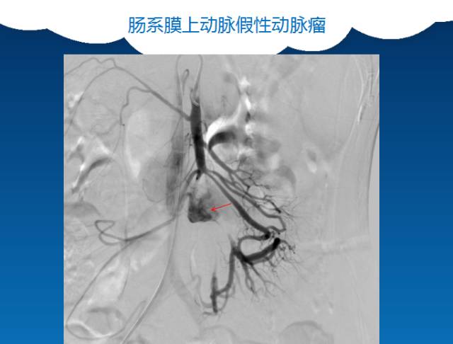 【PPT】肠系膜上动脉夹层