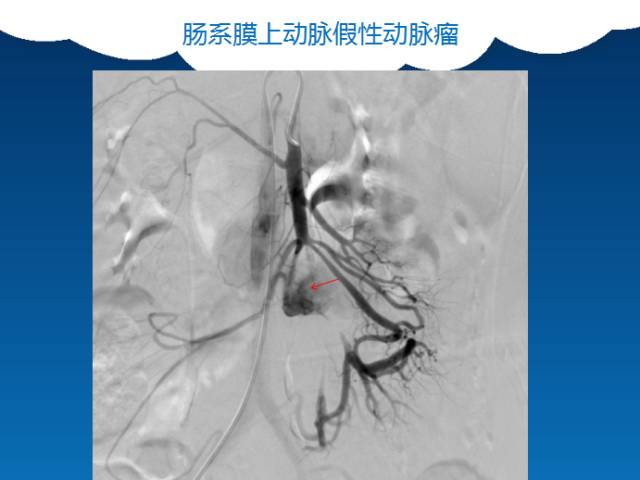 【PPT】肠系膜上动脉夹层