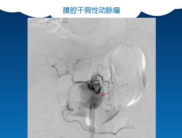 【PPT】肠系膜上动脉夹层