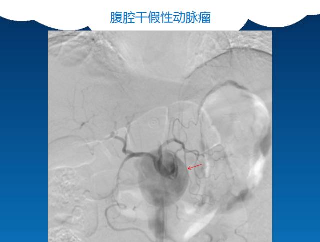 【PPT】肠系膜上动脉夹层