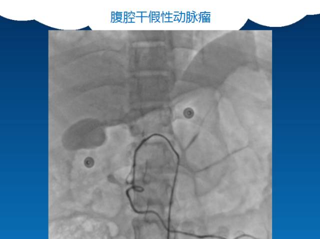 【PPT】肠系膜上动脉夹层