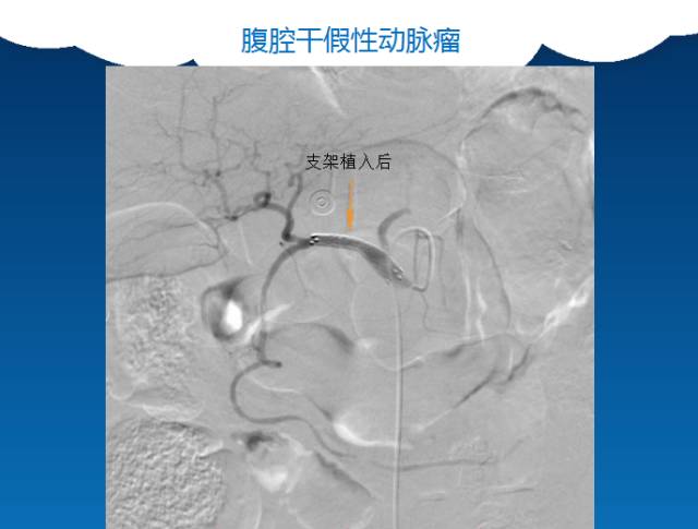 【PPT】肠系膜上动脉夹层