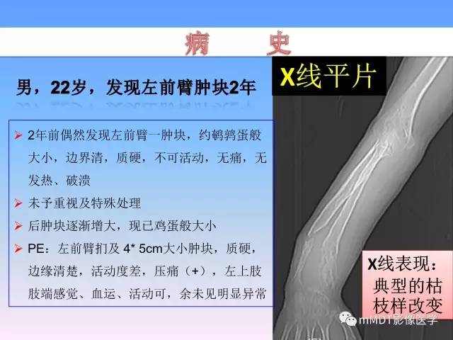 轻松诊断这三个不常见位置的骨巨细胞瘤