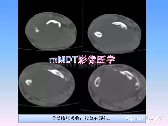 轻松诊断这三个不常见位置的骨巨细胞瘤