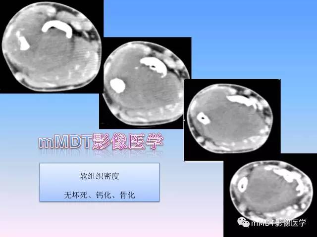 轻松诊断这三个不常见位置的骨巨细胞瘤