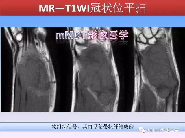 轻松诊断这三个不常见位置的骨巨细胞瘤