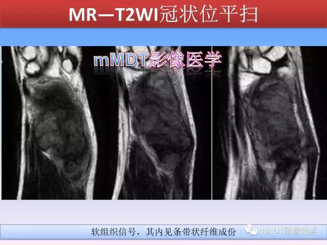 轻松诊断这三个不常见位置的骨巨细胞瘤