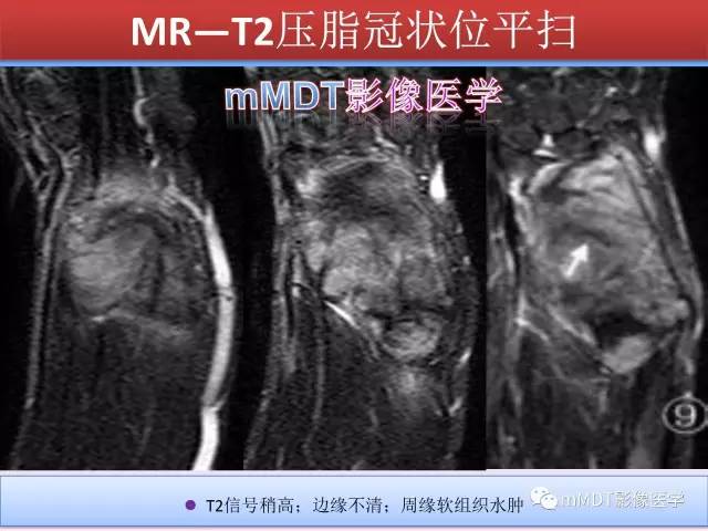 轻松诊断这三个不常见位置的骨巨细胞瘤