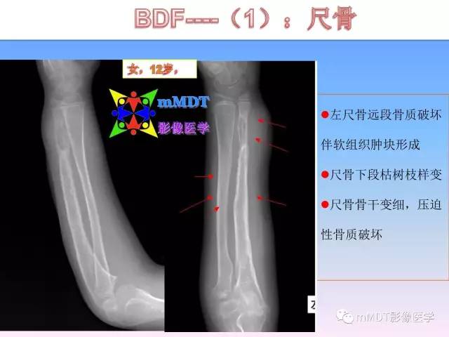 轻松诊断这三个不常见位置的骨巨细胞瘤